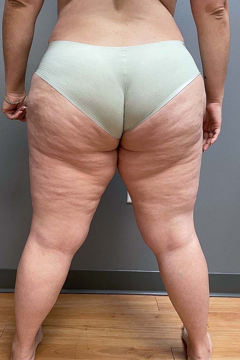 Liposuction Thighs Before & After
