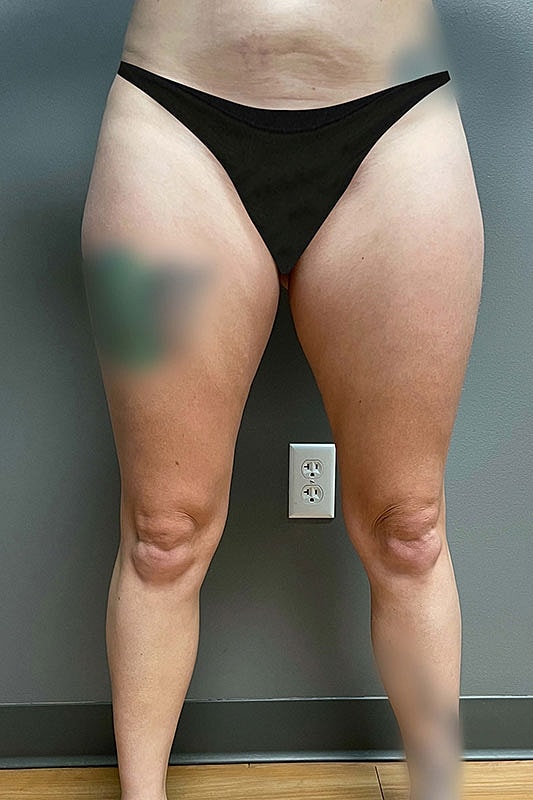 Liposuction Thighs Before & After