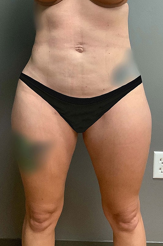 Liposuction Thighs Before & After