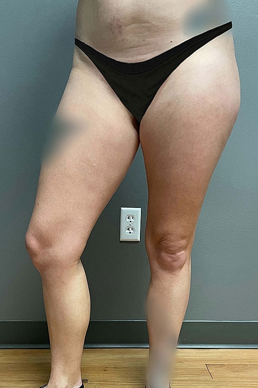 Liposuction Thighs Before & After