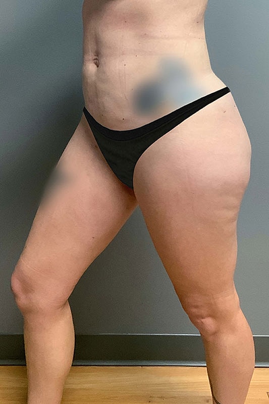 Liposuction Thighs Before & After