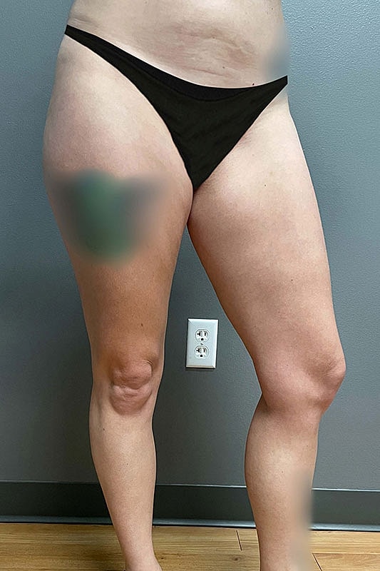 Liposuction Thighs Before & After