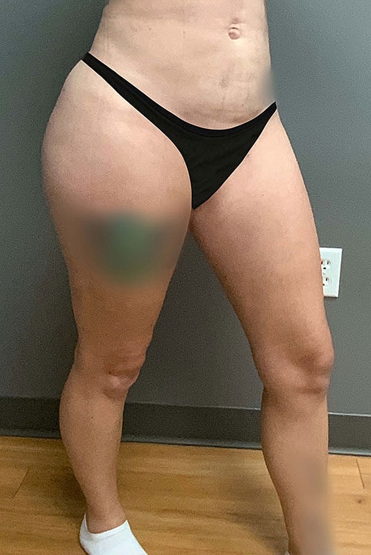 Liposuction Thighs Before & After
