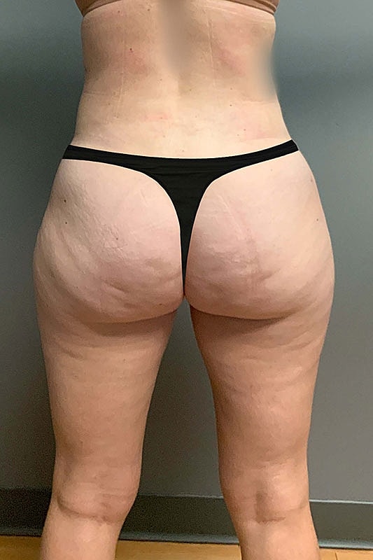 Liposuction Thighs Before & After