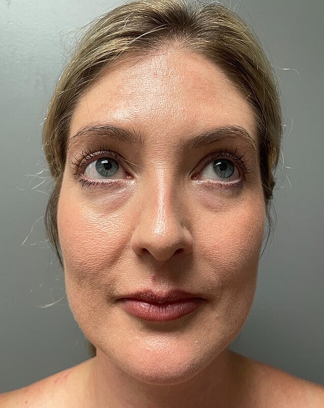 Upper Lip Lift Before & After