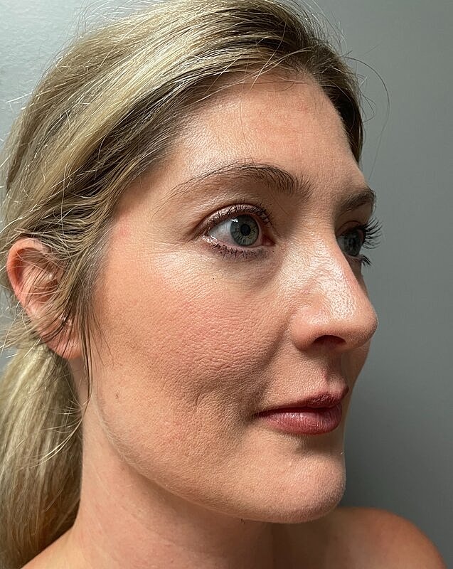 Upper Lip Lift Before & After