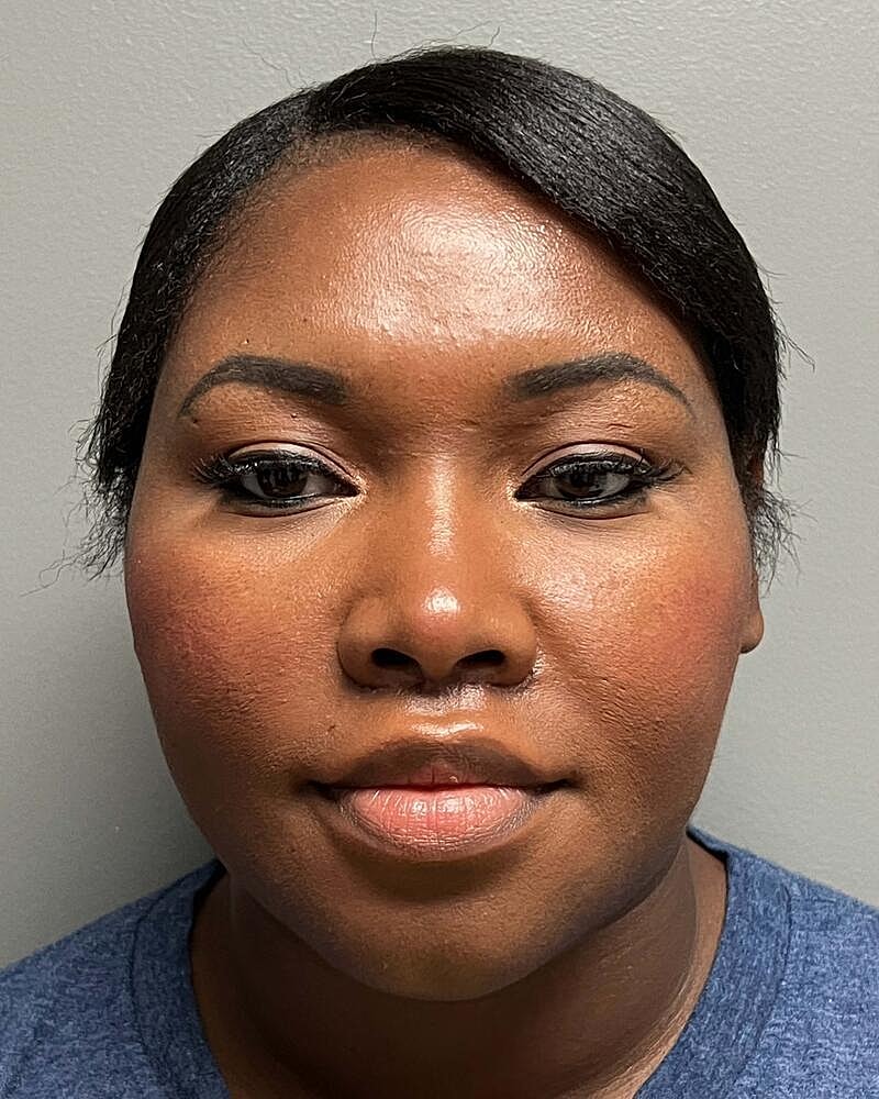 Upper Lip Lift Before & After