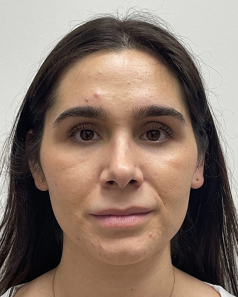 Upper Lip Lift Before & After