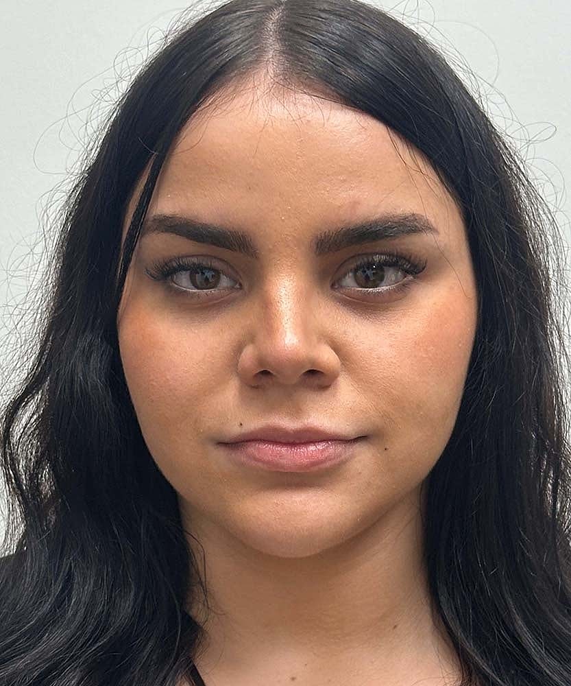 Upper Lip Lift Before & After
