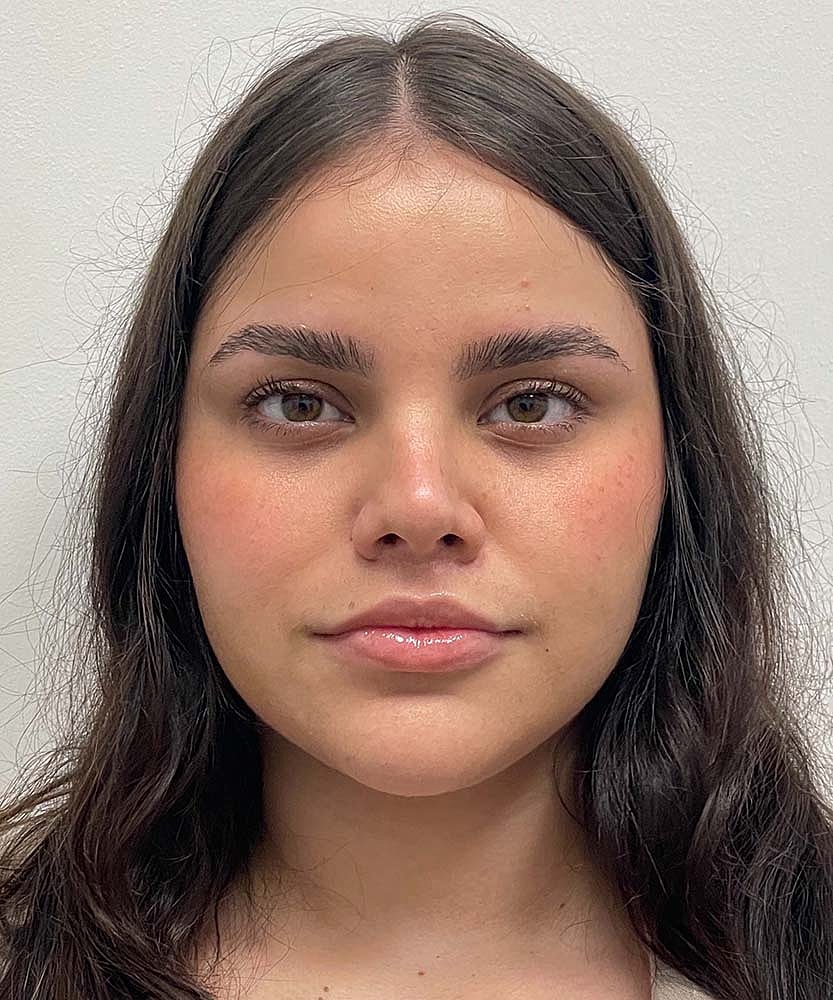 Upper Lip Lift Before & After