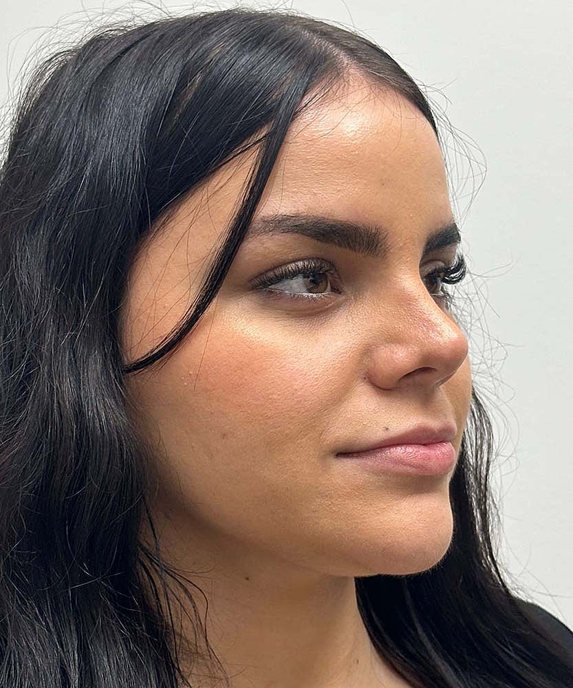 Upper Lip Lift Before & After