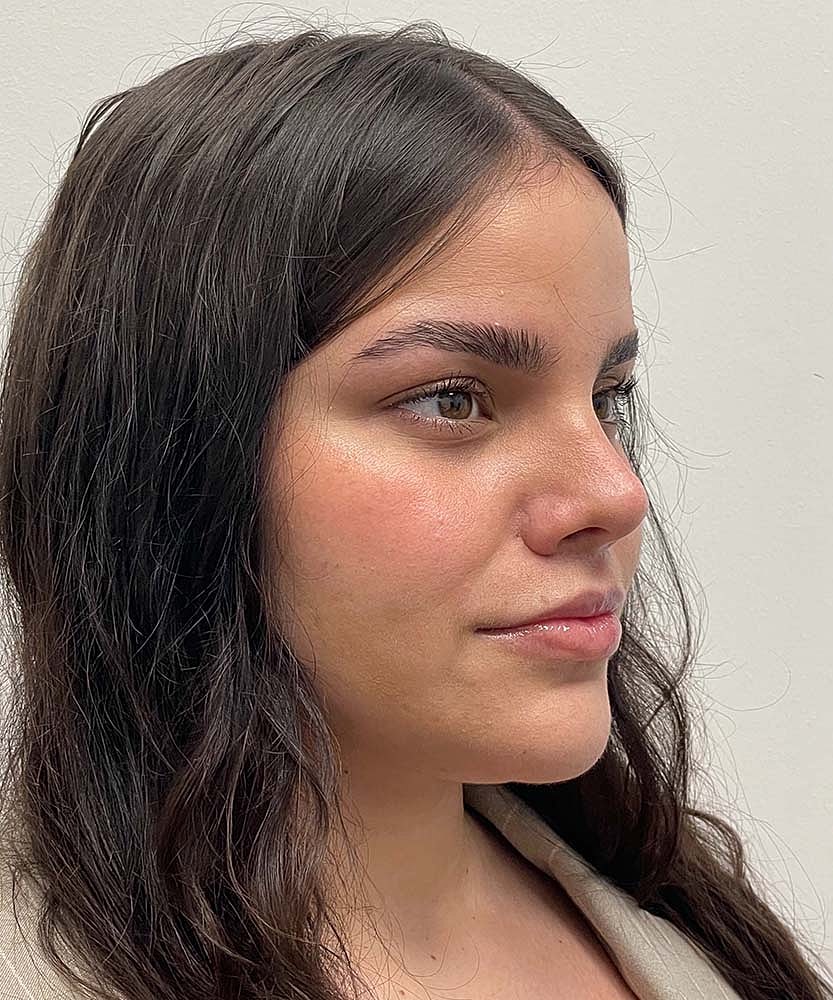 Upper Lip Lift Before & After