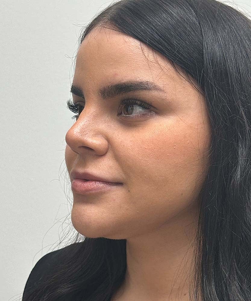 Upper Lip Lift Before & After