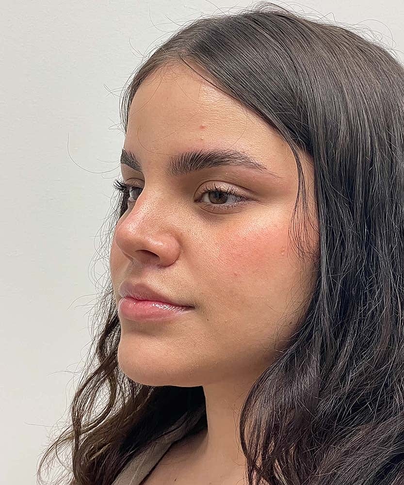 Upper Lip Lift Before & After