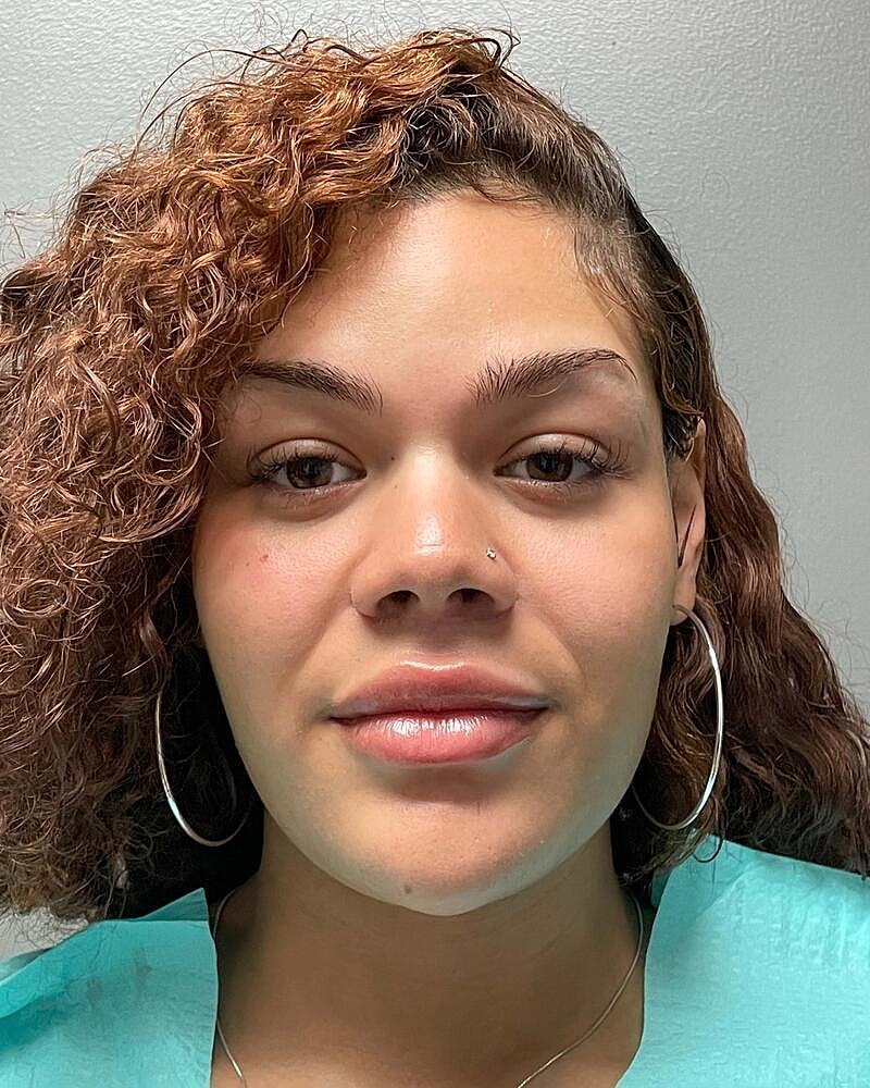 Upper Lip Lift Before & After