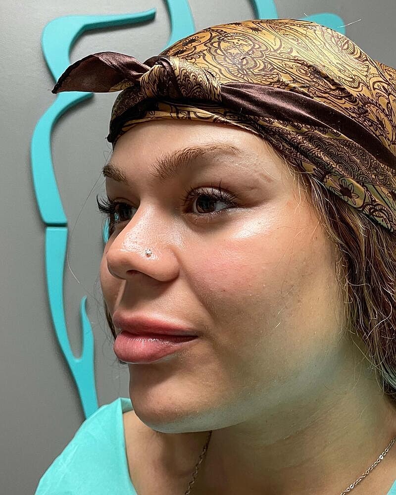 Upper Lip Lift Before & After