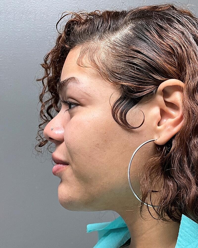 Upper Lip Lift Before & After