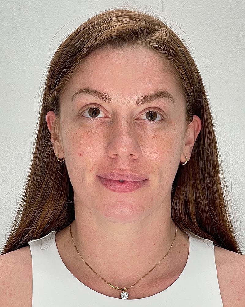 Facial Fat Grafting Before & After