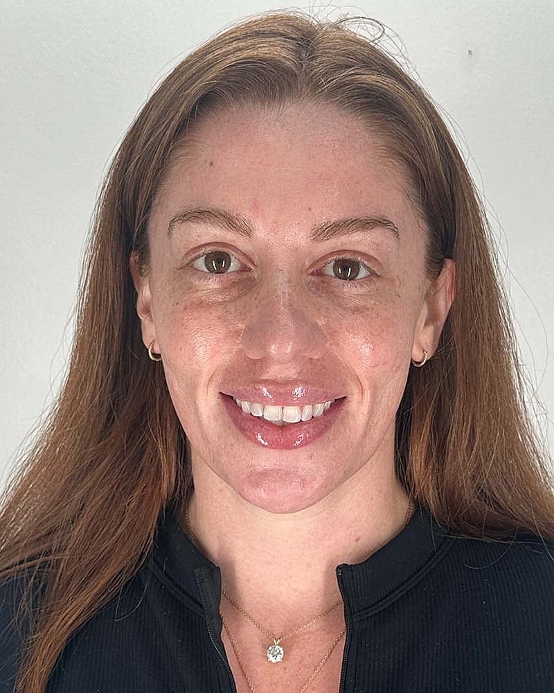 Facial Fat Grafting Before & After
