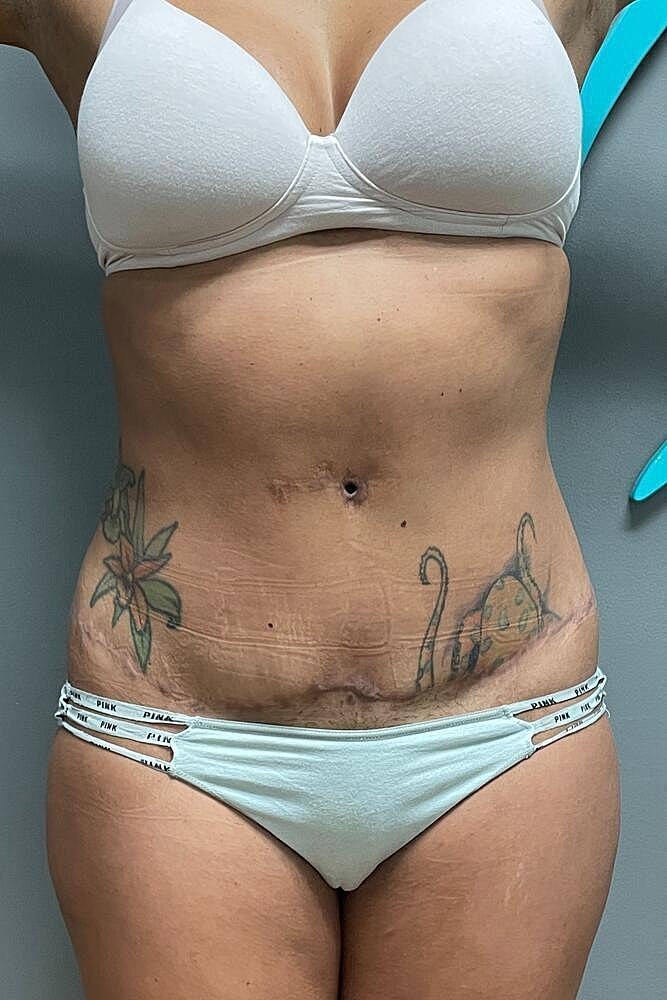 Umbilicoplasty Before & After