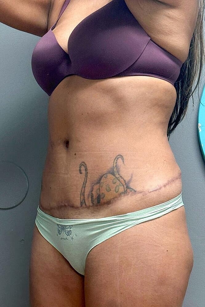 Umbilicoplasty Before & After