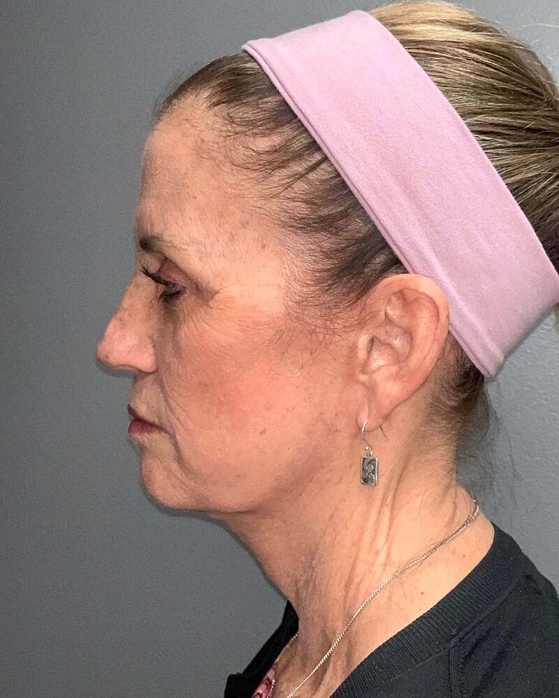 Facelift Before & After