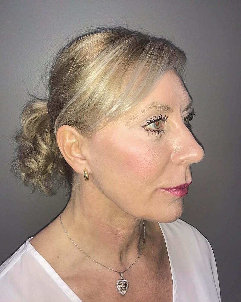 Facelift Before & After