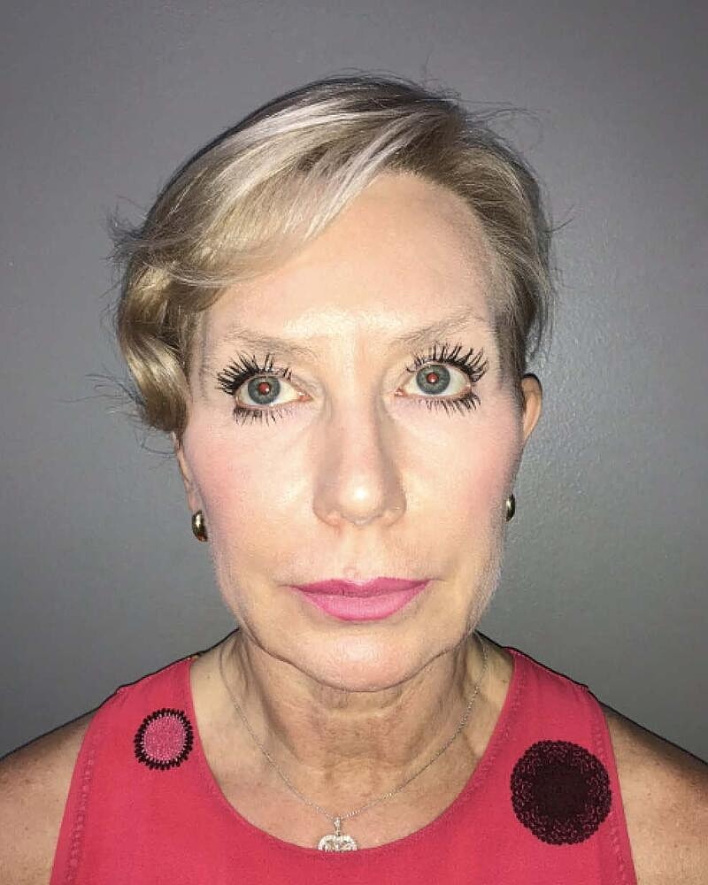 Facelift Before & After