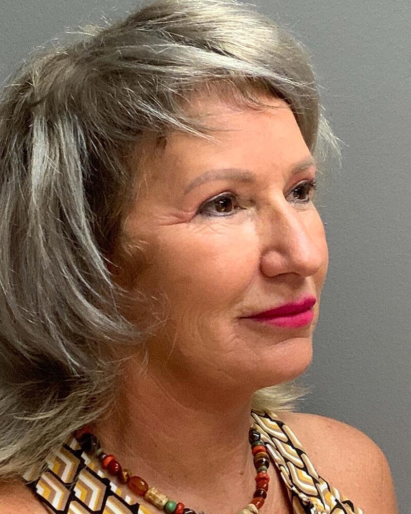 Facelift Before & After