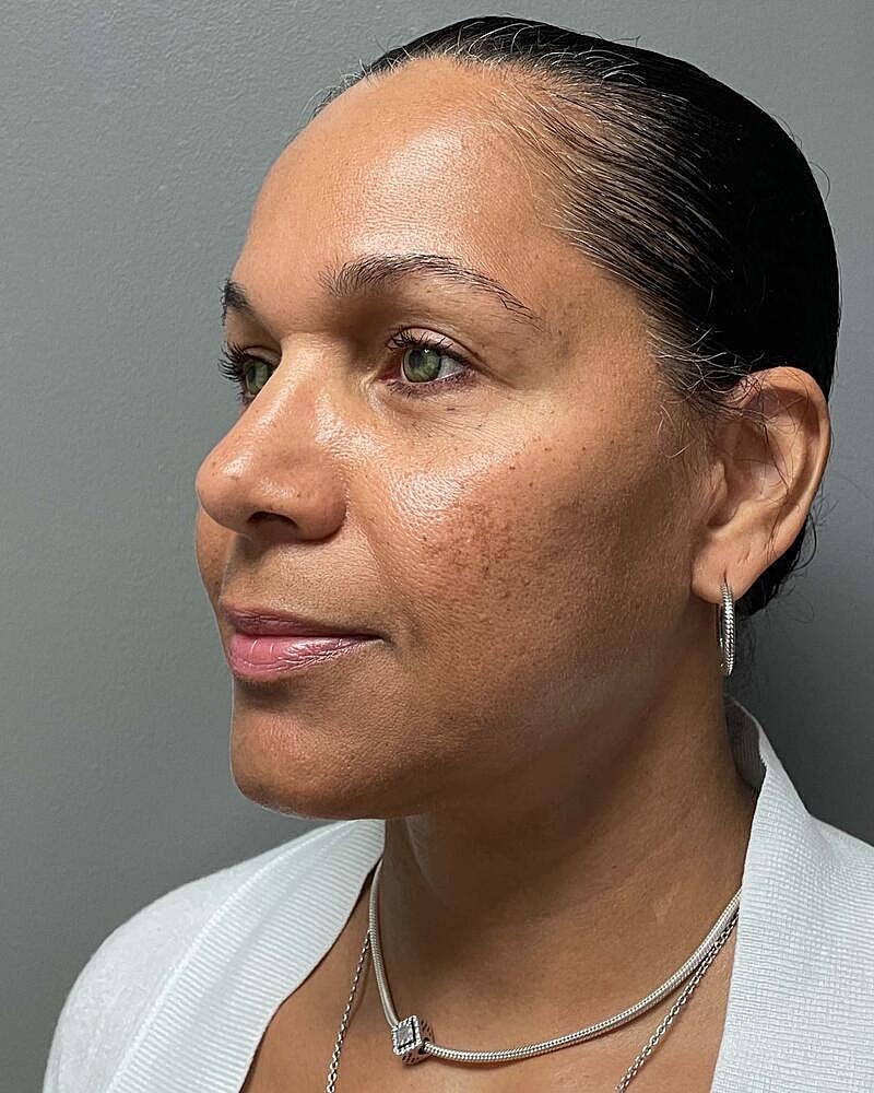 Facelift Before & After