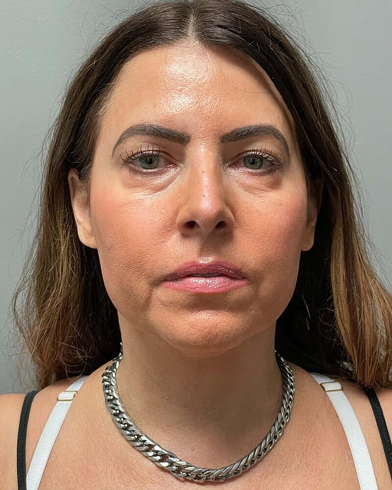 Facelift Before & After