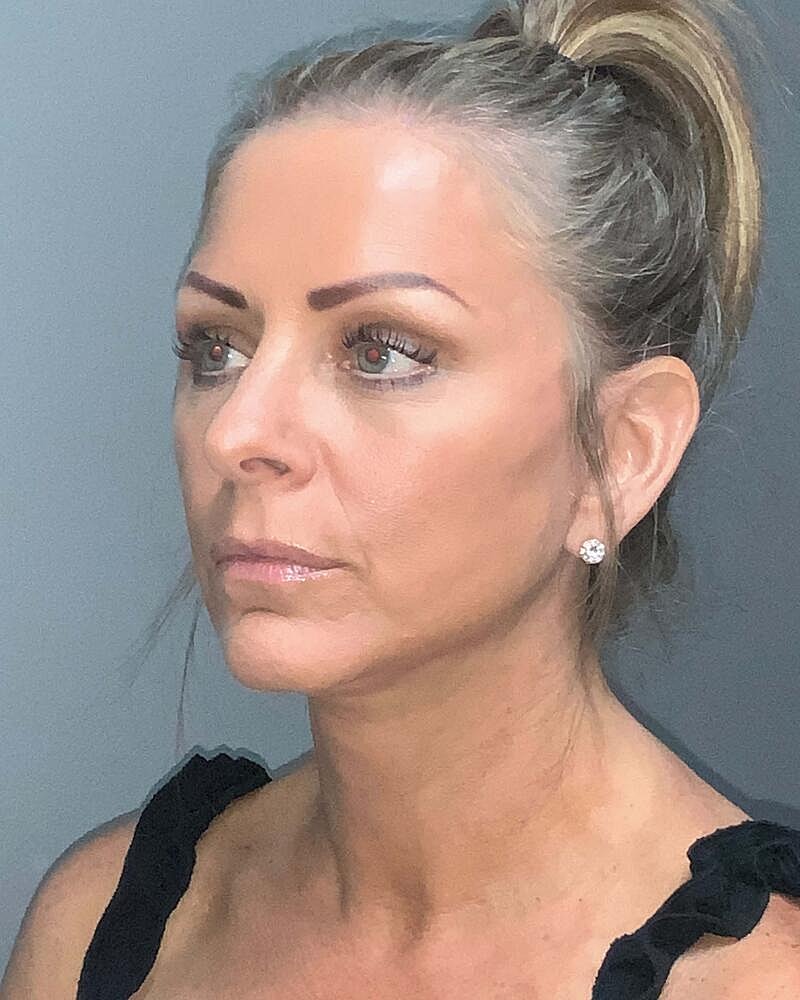 Facelift Before & After