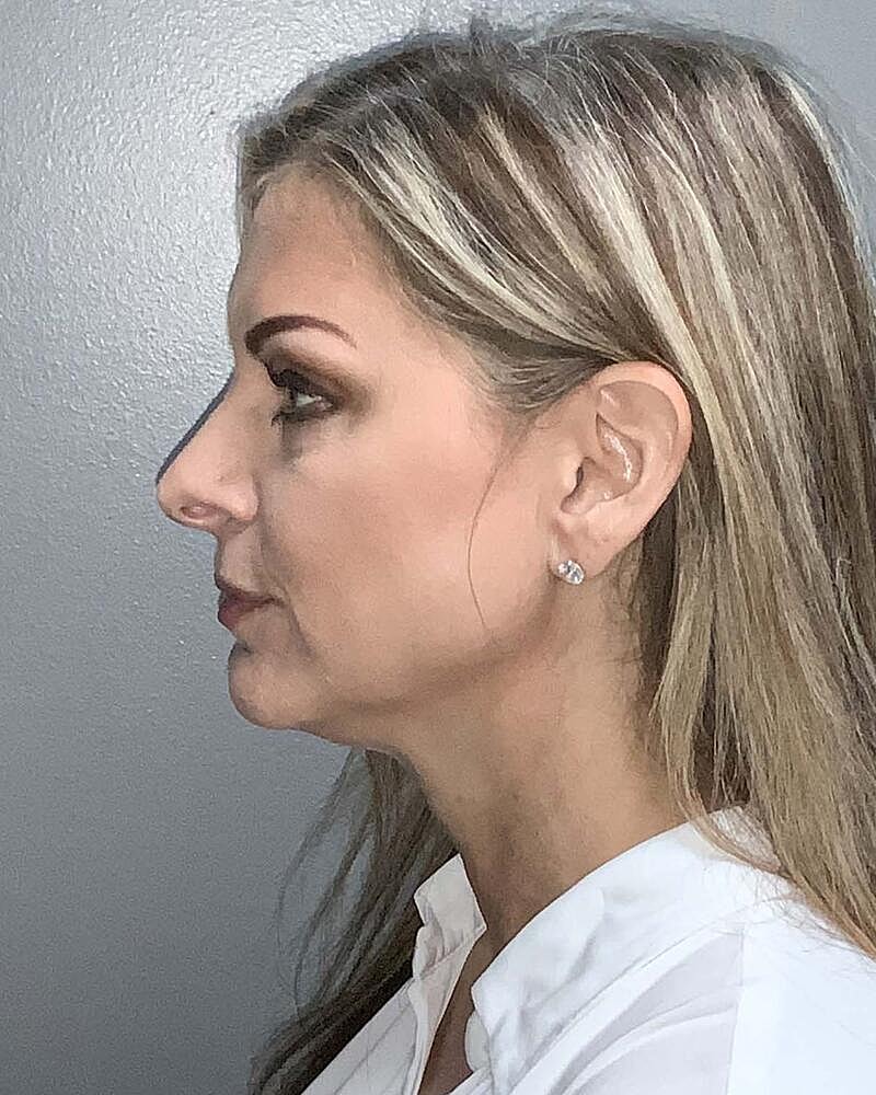 Facelift Before & After