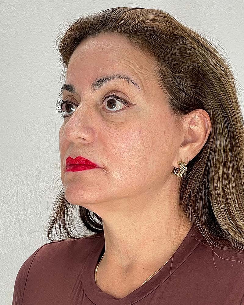 Facelift Before & After