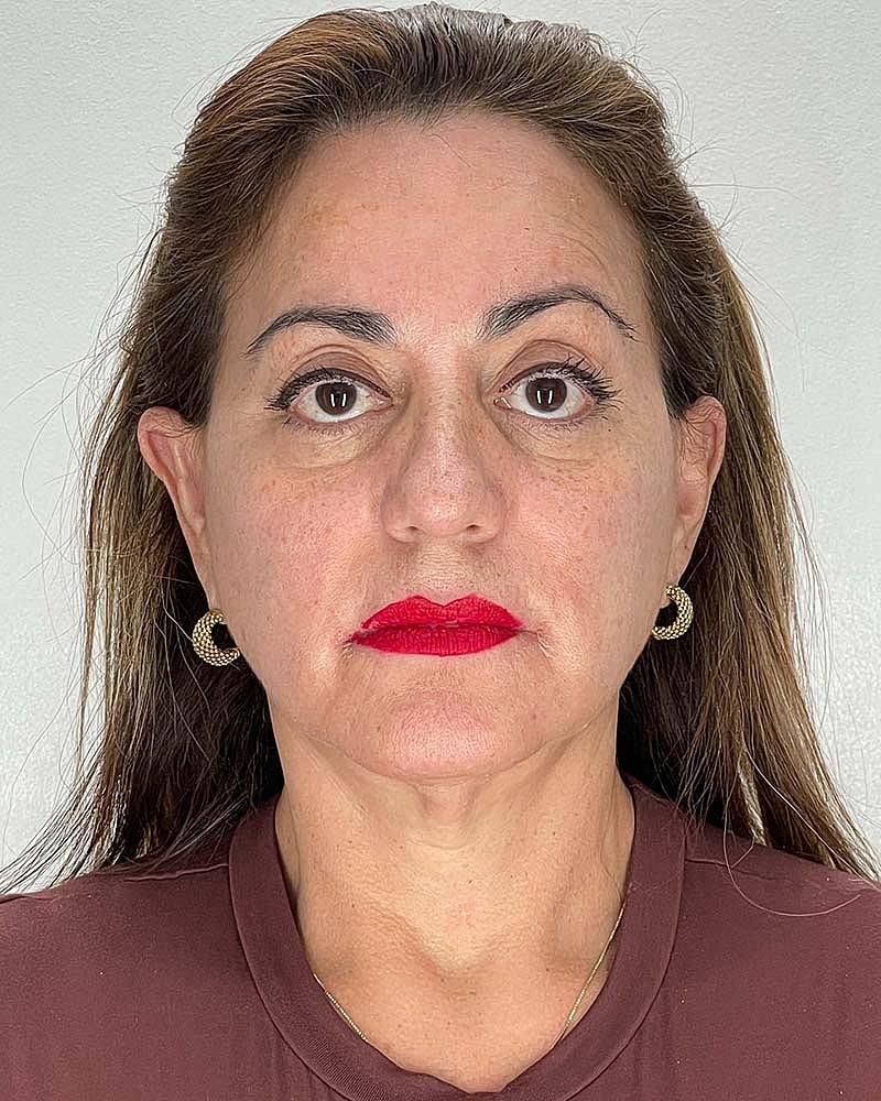 Facelift Before & After