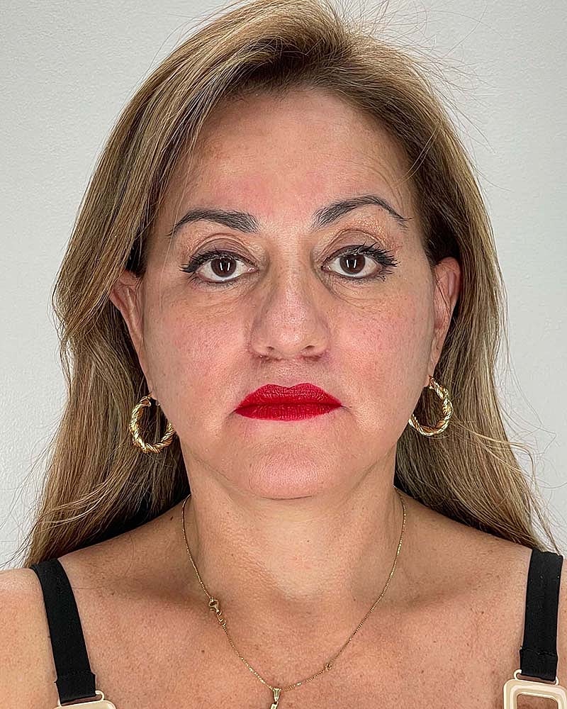 Facelift Before & After