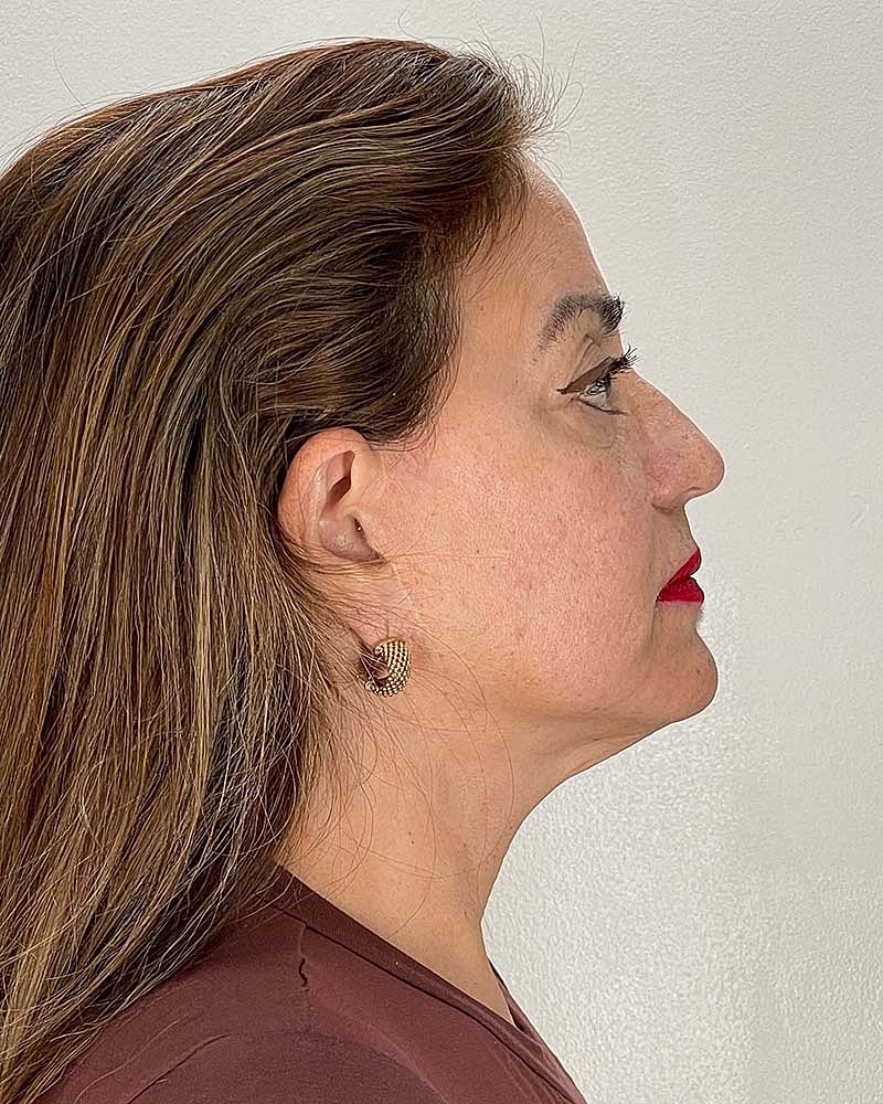 Facelift Before & After