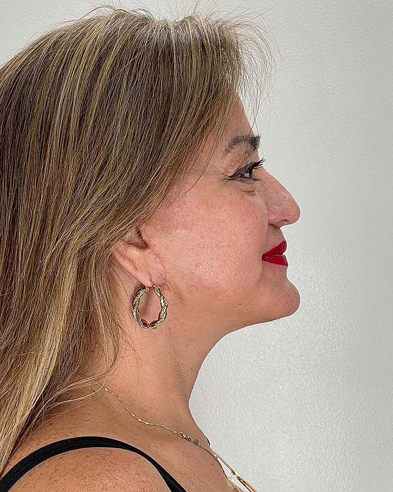 Facelift Before & After