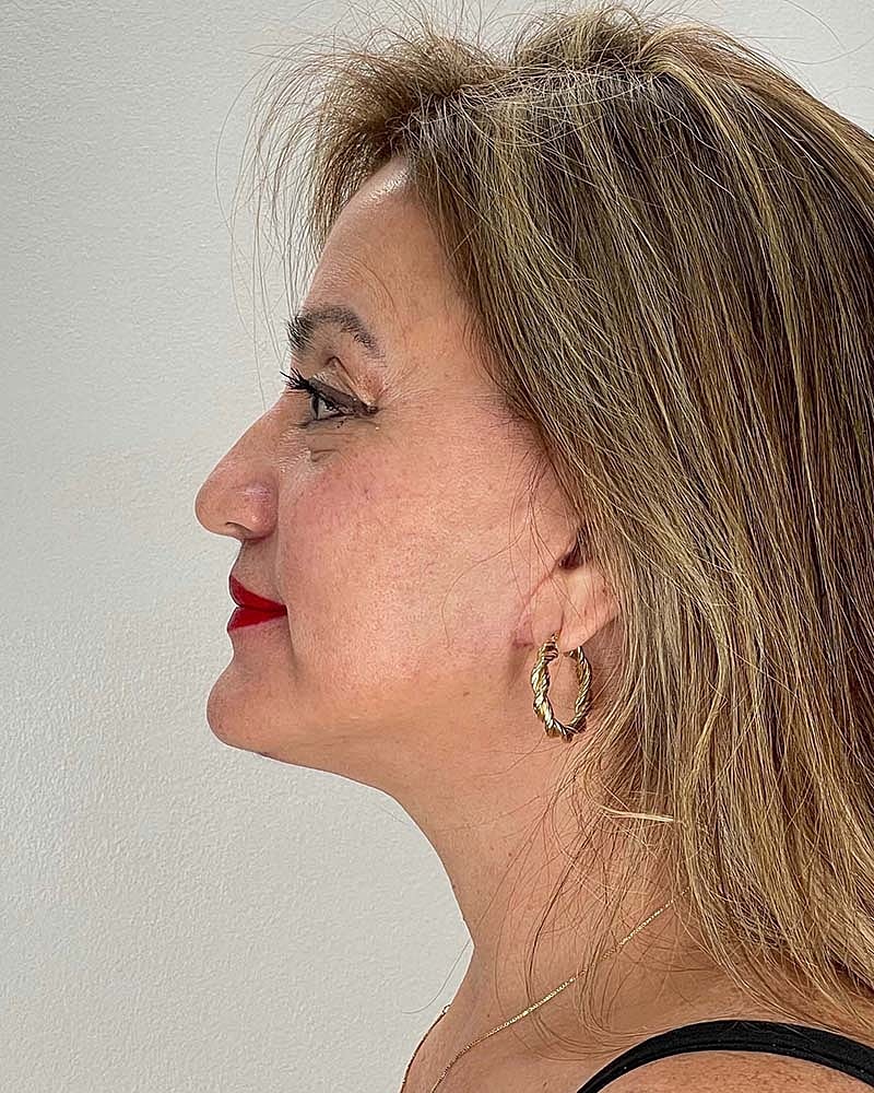 Facelift Before & After