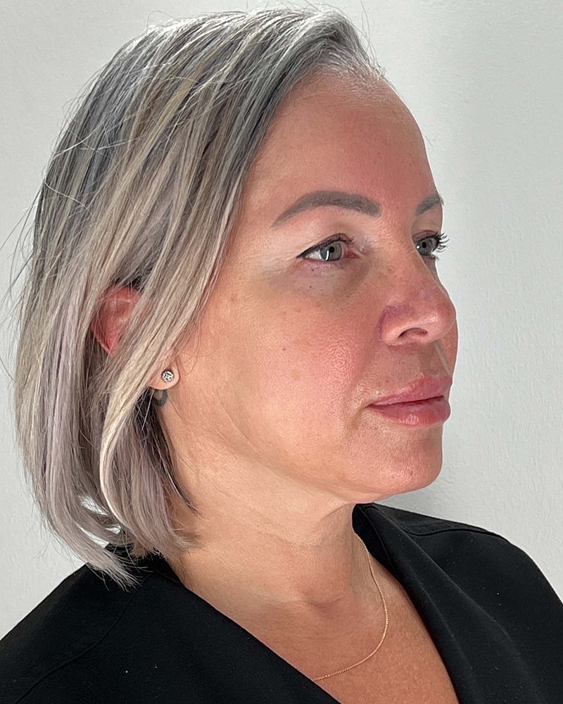 Facelift Before & After