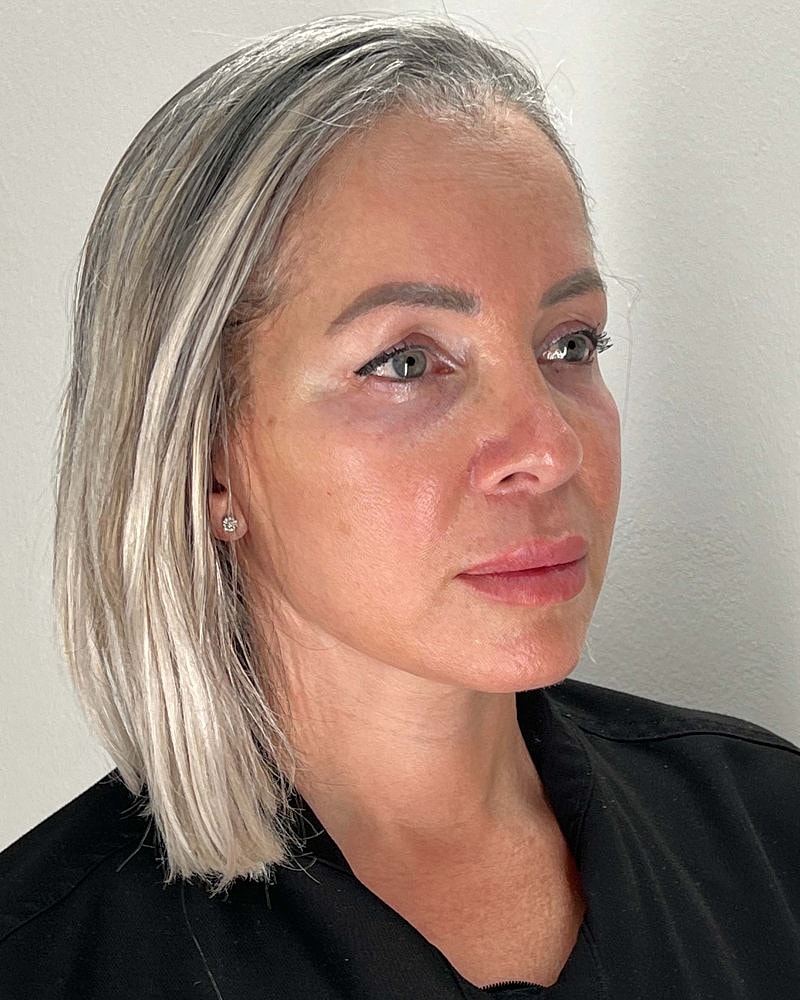 Facelift Before & After