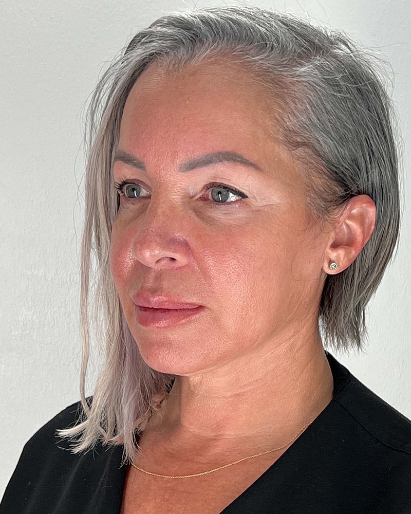 Facelift Before & After