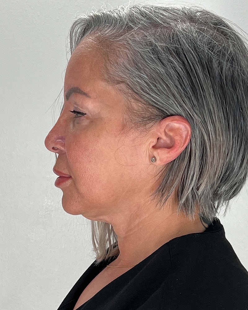 Facelift Before & After