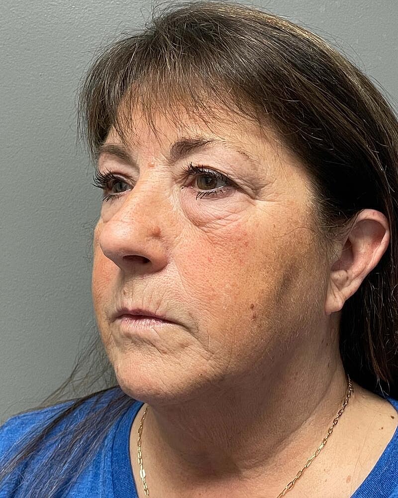 Facelift Before & After