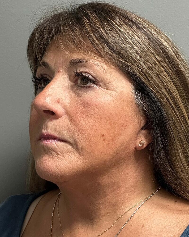 Facelift Before & After