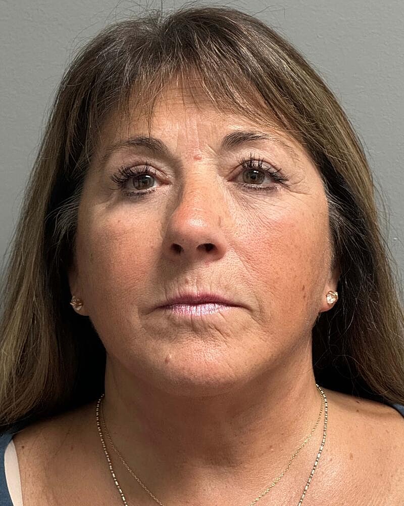 Facelift Before & After