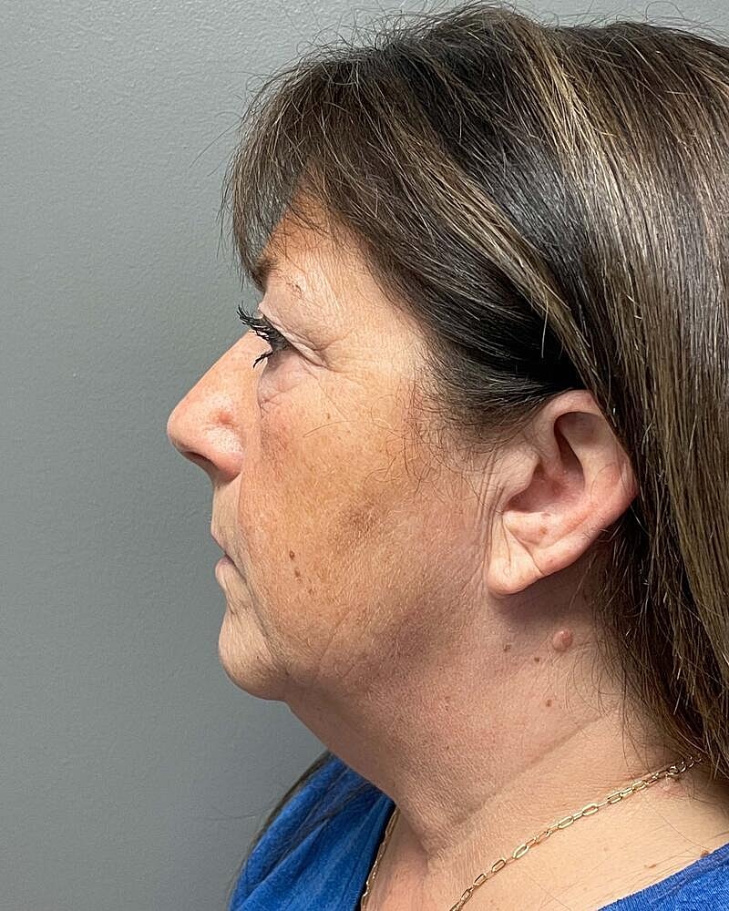 Facelift Before & After