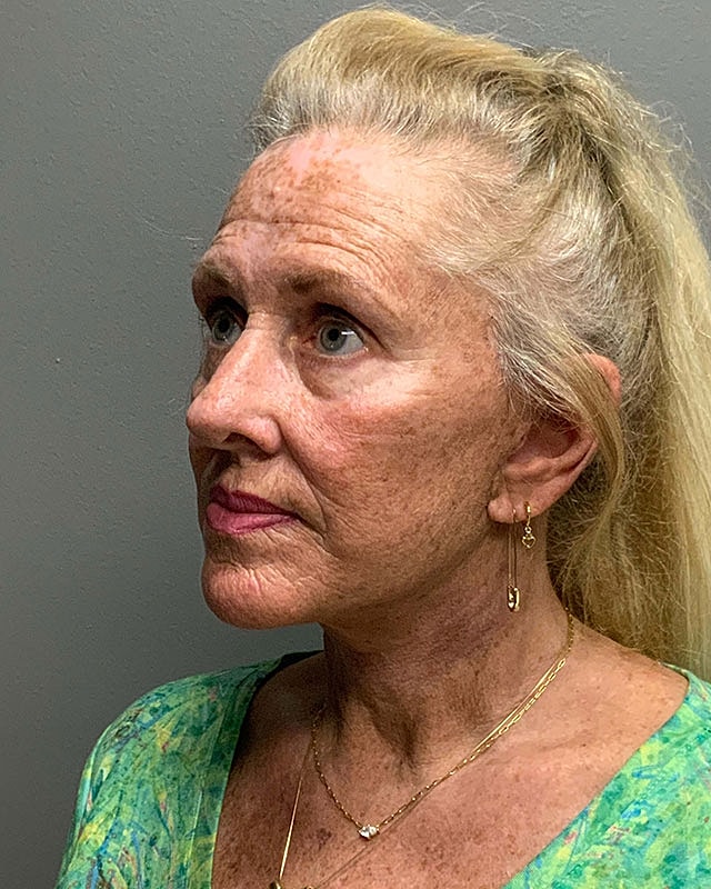 Facelift Before & After