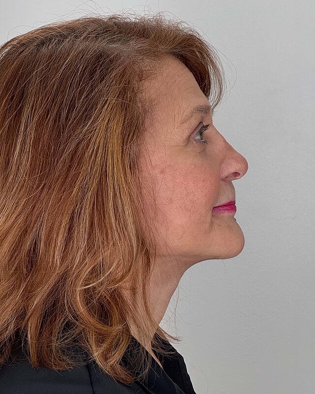 Facelift Before & After