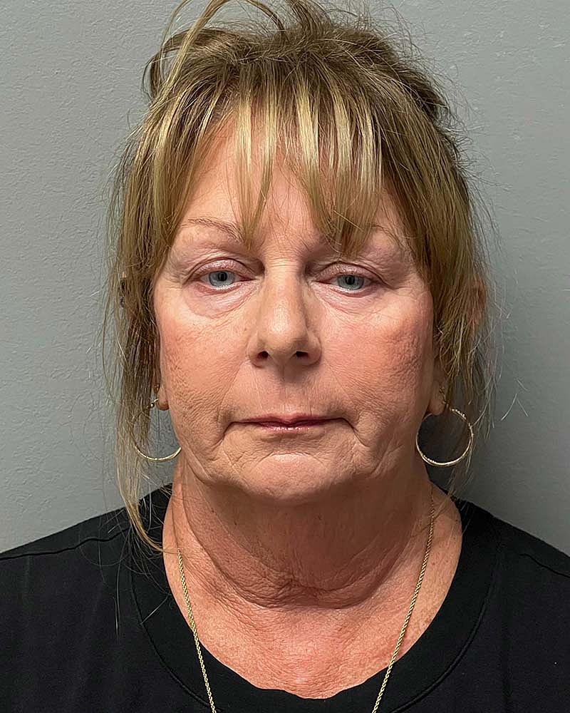 Facelift Before & After